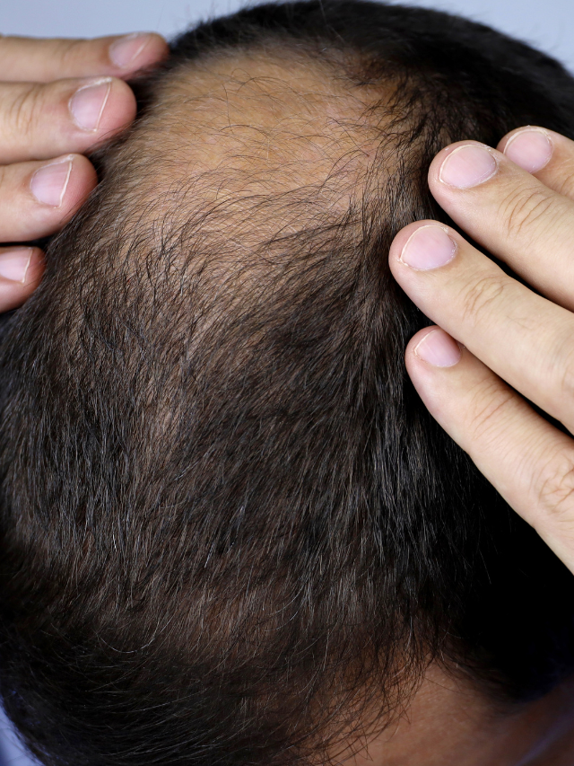 गंजेपन का इलाज – नट्स और सीड्स से बाल फिर से उगाएं
