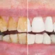irjq6p88_yellow-teeth_625x300_11_April_24